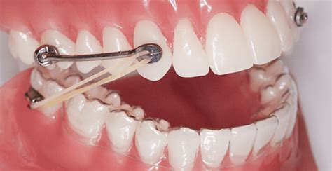 Magical Smile Braces: The Path to Confidence